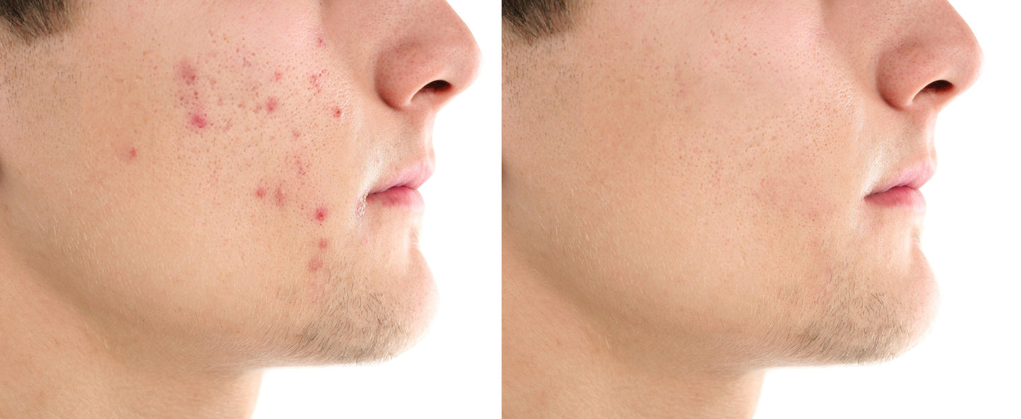 Advanced Acne Care Mask- Coral Reef