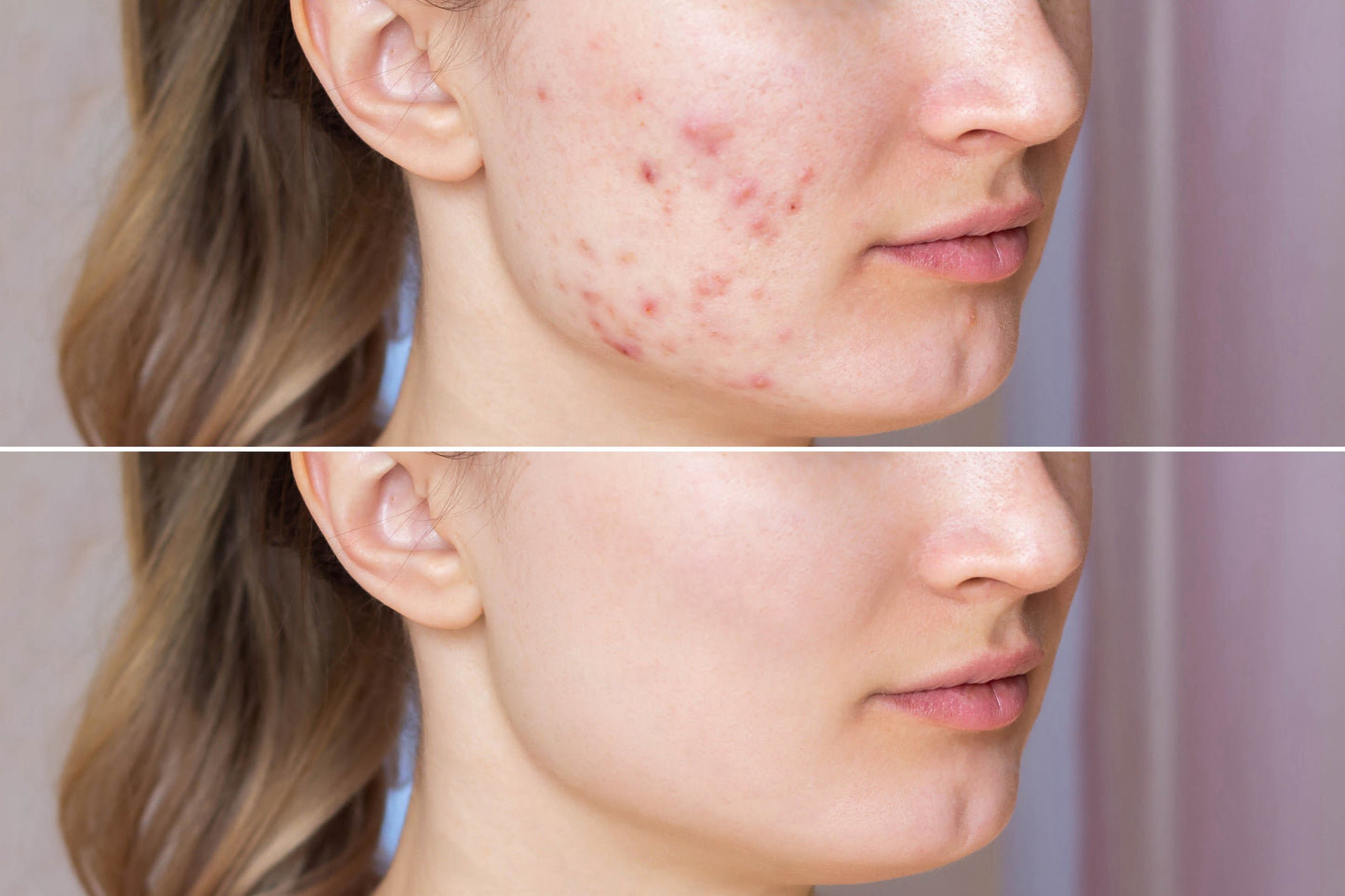 Advanced Acne Care Mask- Coral Reef