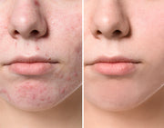 STRONG Acne Spot Treatment - Advanced Acne Care- Coral Reef