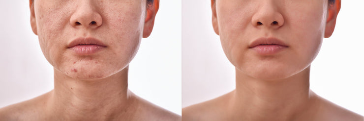 STRONG Acne Spot Treatment - Advanced Acne Care- Coral Reef